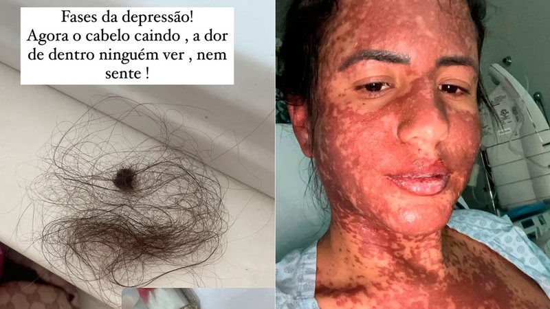 Carol Aguiar lamentou queda de cabelo após doença de pele - Foto: Reprodução/ Instagram@caroline.luzaguiar