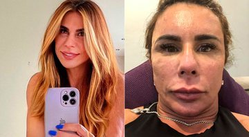Andrea Sunshine antes e depois de harmonização facial que deu errado - Foto: Arquivo pessoal