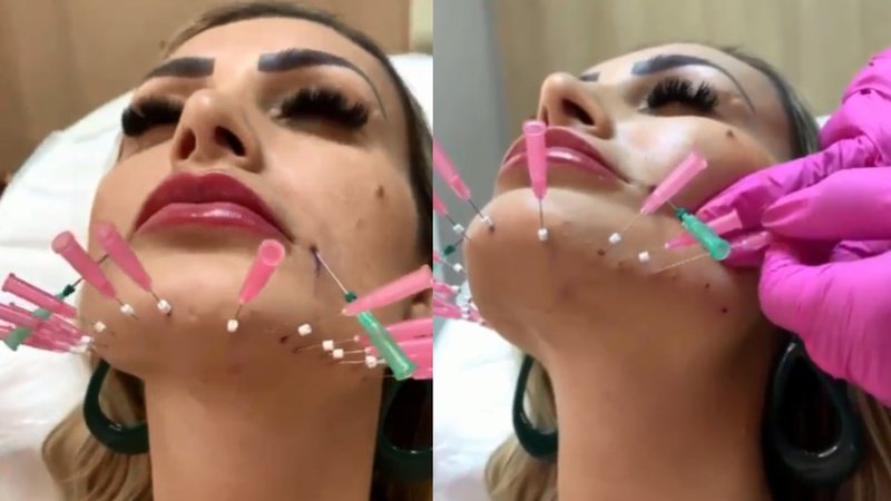 Andressa explicou estar fazendo tratamento para elminar flacidez do rosto - Reprodução/Instagram