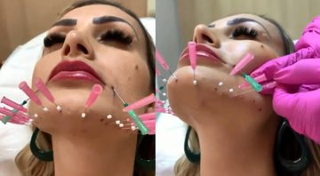 Andressa explicou estar fazendo tratamento para elminar flacidez do rosto - Reprodução/Instagram