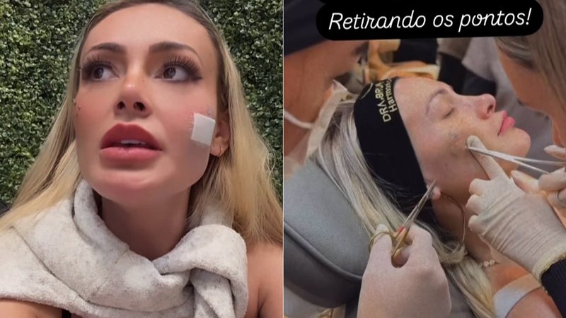 Andressa Urach retirou pontos do rosto e fez botox - Foto: Reprodução/ Instagram@andressaurachoficial