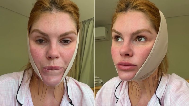 Bárbara Evans mostrou antes e depois de solução para a papada - Foto: Reprodução/ Instagram@barbaraevans22