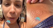 Belle Silva compartilha imagens de queimadura feita por água-viva - Foto: Reprodução / Instagram @bellesilva