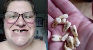 Danielle revelou que a remoção dos dentes contou apenas com uma "simples torção ou puxão" - Foto / Reprodução