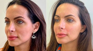 Carla Prata mostrou antes e depois de procedimentos no rosto - Foto: Reprodução/ Instagram@carlaprata