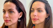 Carla Prata mostrou antes e depois de procedimentos no rosto - Foto: Reprodução/ Instagram@carlaprata