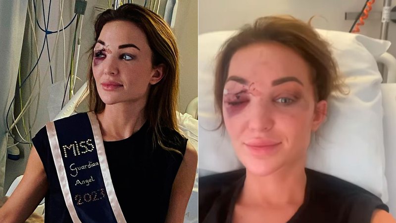 Chayenne van Aarle exibiu ferimento no rosto após grave acidente de carro - Foto: Reprodução/ Instagram@chayennevanaarle