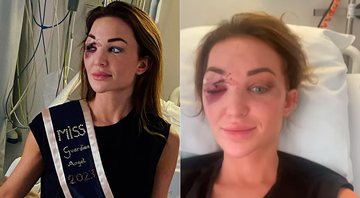 Chayenne van Aarle exibiu ferimento no rosto após grave acidente de carro - Foto: Reprodução/ Instagram@chayennevanaarle