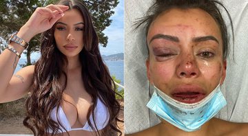 Yasmine Pierards quebrou o nariz após ser agredida por homem que se recusou a deixar sua casa após festa - Foto: Reprodução/ Instagram