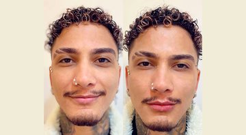 Dynho Alves mostra resultados da harmonização facial - Reprodução