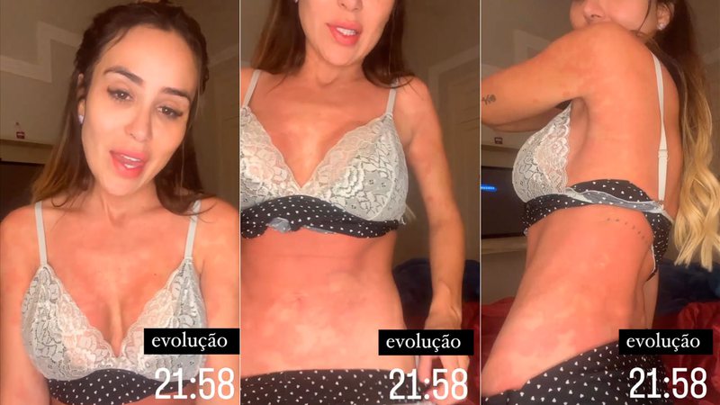 Letícia Santiago impressionou ao mostrar inflamação cutânea - Foto: Reprodução/ Instagram@le_santiago