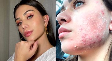 Flávia Pavanelli mostrou rosto tomado por acne e falou sobre problema de pele - Foto: Reprodução/ Instagram