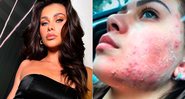 Flavia Pavanelli contou que perdeu trabalhos por conta da acne - Foto: Reprodução/Instagram@flaviapavanelli