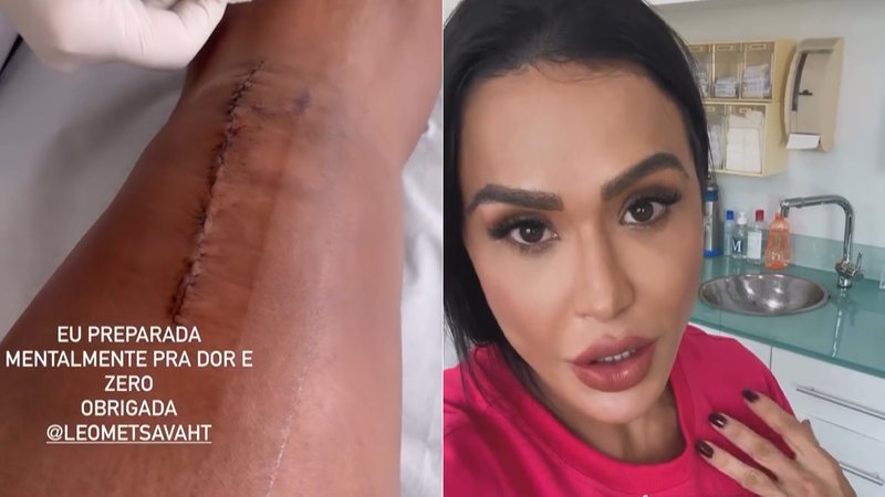 Gracyanne Barbosa surpreendeu ao mostrar cicatriz no joelho