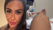 Gracyanne Barbosa mostrou punção no joelho para a retirada de líquido