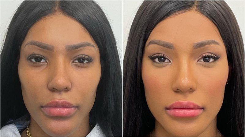 Carol Lekker mostrou o antes e depois da harmonização facial - Foto: Reprodução