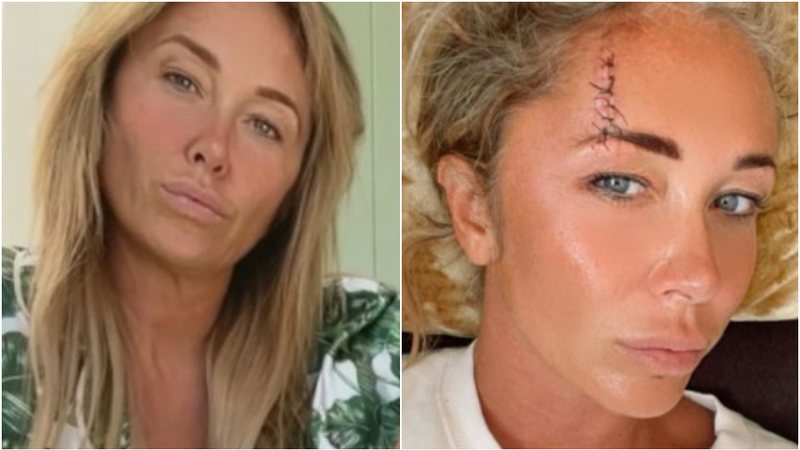 Jenny Frost apareceu com enorme cicatriz no rosto após acidente - Foto: Reprodução / Instagram
