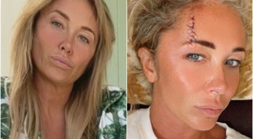 Jenny Frost apareceu com enorme cicatriz no rosto após acidente - Foto: Reprodução / Instagram