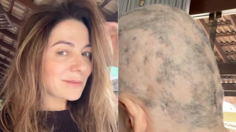 Tratando alopecia, Karina Lucco mostrou falhas na cabeça