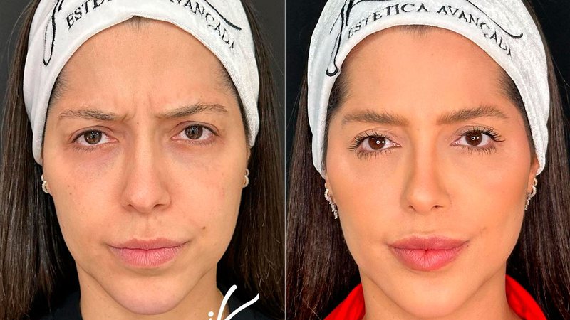 Laís Caldas mostrou resultado de harmonização facial - Foto: Reprodução/ Instagram@dra.laiscaldass