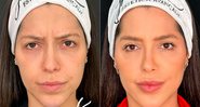 Laís Caldas mostrou resultado de harmonização facial - Foto: Reprodução/ Instagram@dra.laiscaldass