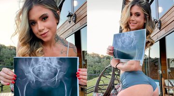 Larissa Sumpani fez raio-x para provar que seu bumbum é natural - Foto: Reprodução/ Instagram@eusumpani