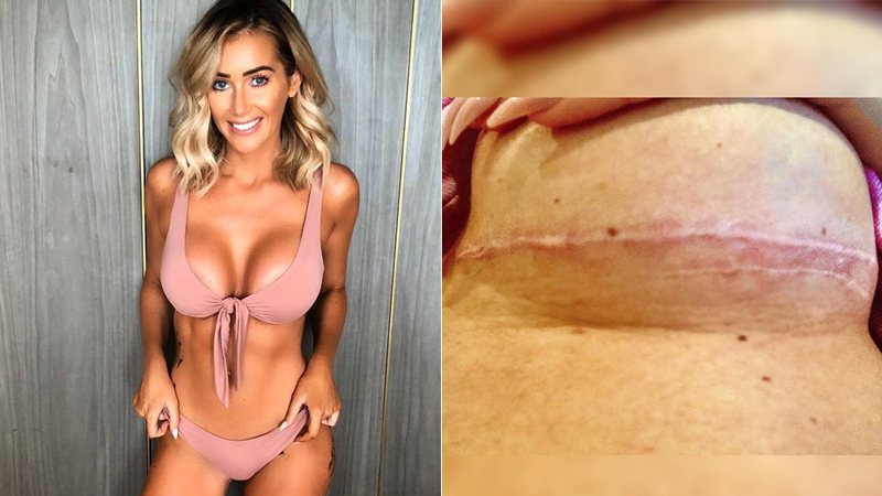 Laura Anderson ficou com cicatrizes após tentar diminuir implante de silicone - Foto: Reprodução/ Instagram