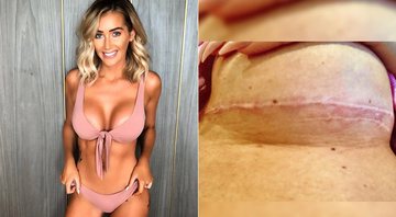 Laura Anderson ficou com cicatrizes após tentar diminuir implante de silicone - Foto: Reprodução/ Instagram