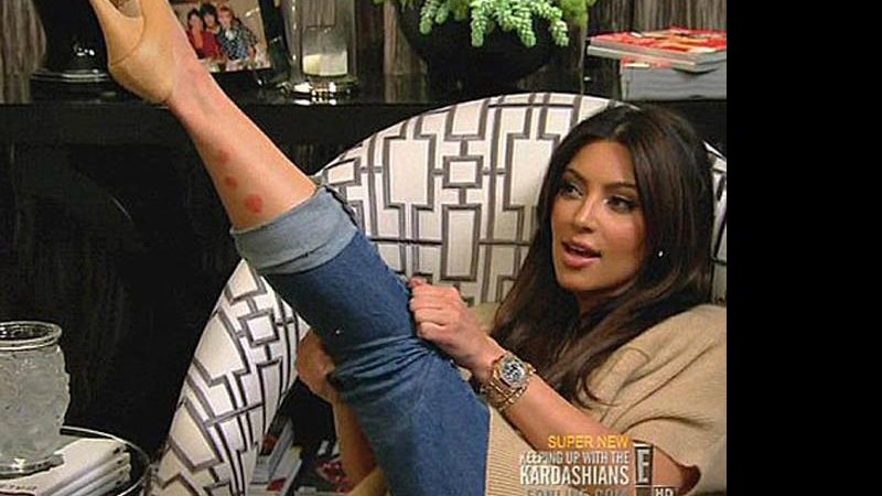 Imagem Kim Kardashian mostra as feridas de sua doença de pele