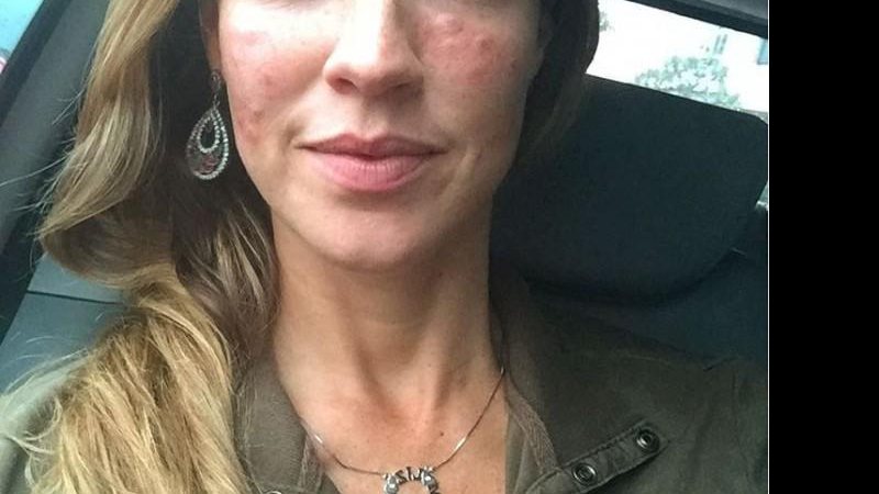 Luana Piovani mostra seu rosto inchado após tratamento de pele - Foto: Reprodução/Instagram