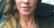 Luana Piovani mostra seu rosto inchado após tratamento de pele - Foto: Reprodução/Instagram