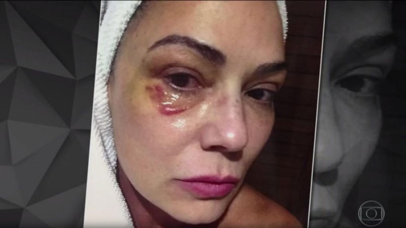 Luiza Brunet exibe machucado no Fantástico - Foto: Reprodução/ TV Globo