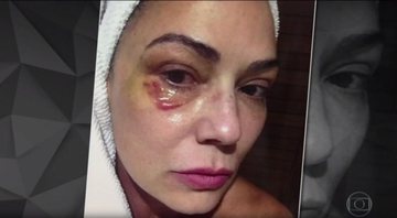 Luiza Brunet exibe machucado no Fantástico - Foto: Reprodução/ TV Globo