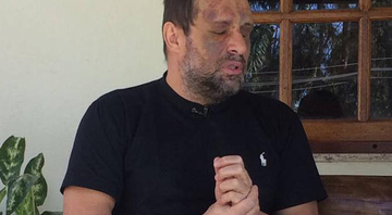 Ex-Polegar Ricardo Costa mostra o rosto cheio de hematomas após briga com cunhado - Foto: Divulgação/ Domingo Show
