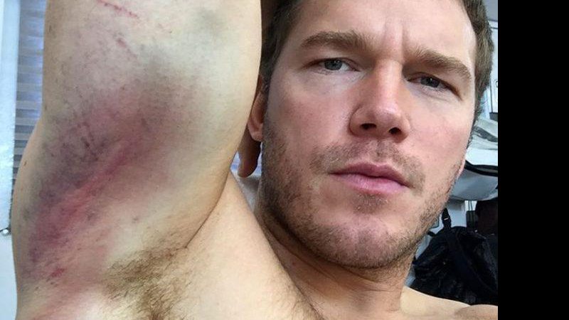Chris Pratt mostra hematomas adquiridos durante as filmagens de “Passageiros” - Foto: Reprodução/ Instagram