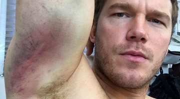 Chris Pratt mostra hematomas adquiridos durante as filmagens de “Passageiros” - Foto: Reprodução/ Instagram