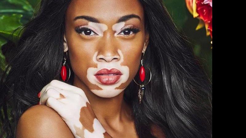 Winnie Harlow assumiu o vitiligo e conquistou o mundo da moda - Foto: Reprodução/ Instagram