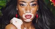 Winnie Harlow assumiu o vitiligo e conquistou o mundo da moda - Foto: Reprodução/ Instagram