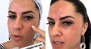 Graciele Lacerda mostra antes e depois do botox na web - Foto: Reprodução/ Instagram