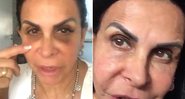 Gretchen antes e depois de passar pelo procedimento para camuflar as olheiras - Foto: Reprodução/ Instagram