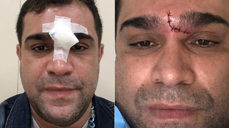 Evandro Santo cortou o rosto após levar um tombo no banheiro de casa - Foto: Reprodução/ Instagram