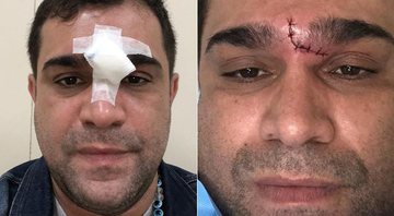 Evandro Santo cortou o rosto após levar um tombo no banheiro de casa - Foto: Reprodução/ Instagram