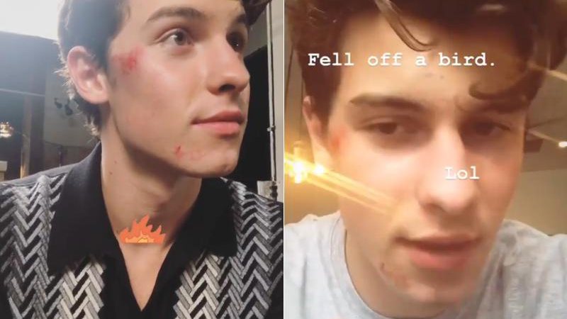 Shawn Mendes machucou o rosto ao cair de patinete elétrico - Foto: Reprodução/ Instagram