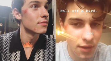 Shawn Mendes machucou o rosto ao cair de patinete elétrico - Foto: Reprodução/ Instagram