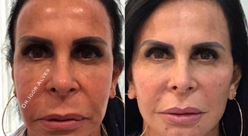 Gretchen mostrou resultado de harmonização facial na web - Foto: Reprodução/ Instagram