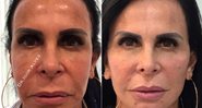 Gretchen mostrou resultado de harmonização facial na web - Foto: Reprodução/ Instagram