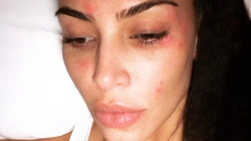 Imagem Kim Kardashian mostra as marcas da psoríase – saiba o que é essa doença autoimune