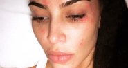 Imagem Kim Kardashian mostra as marcas da psoríase – saiba o que é essa doença autoimune
