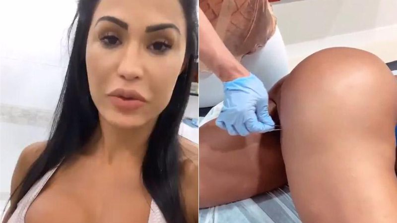 Gracyanne trata lesão no bumbum usando procedimento com agulhas - Foto: Reprodução/ Instagram