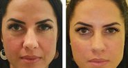 Graciele Lacerda surpreende seguidores com resultado de harmonização facial: “Super satisfeita” - Foto: Reprodução/Instagram